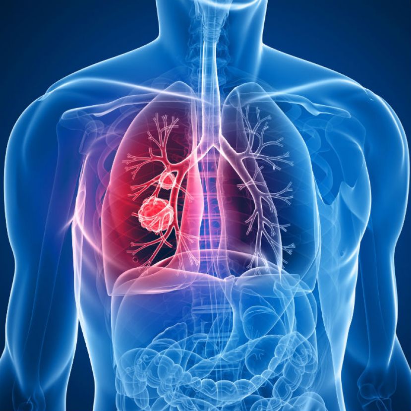 Cáncer de pulmón; aprende a combatirlo