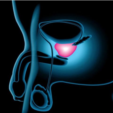 ¡Ojo hombres!: sube el cáncer de próstata