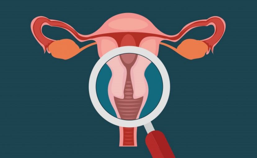 Cáncer de ovario, qué debes saber
