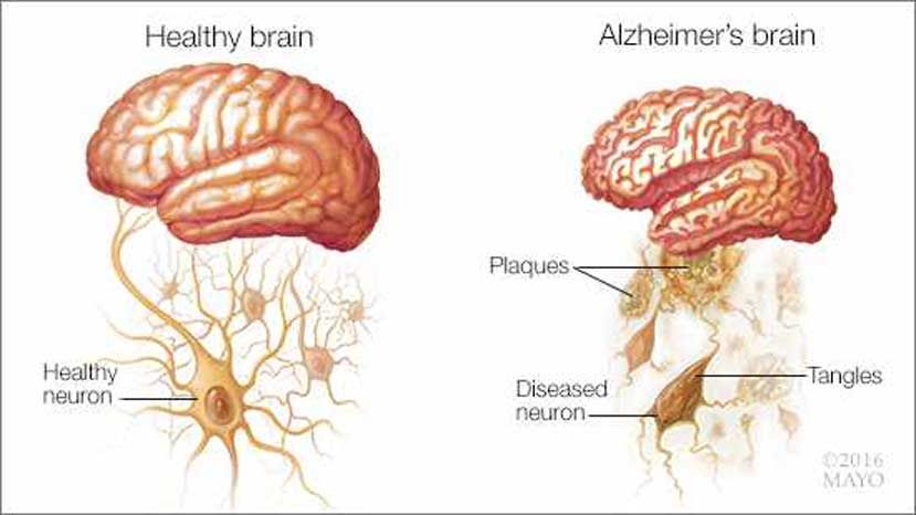 ¿Sabes cómo diagnosticar el Alzheimer a tiempo?