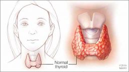 Mitos sobre el Hipotiroidismo