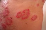 Psoriasis, larga historia en su combate