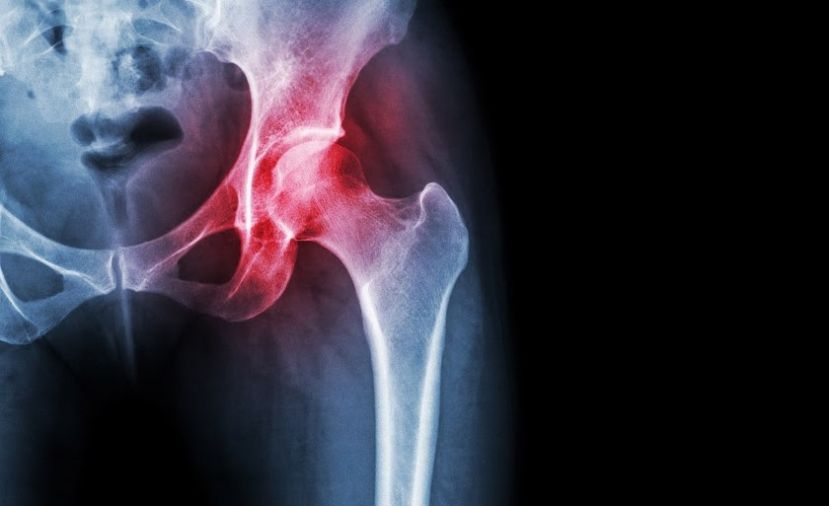 Osteoartritis y artritis… ¿son lo mismo?