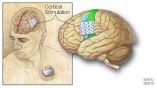 La estimulación eléctrica ayuda a pacientes con epilepsia