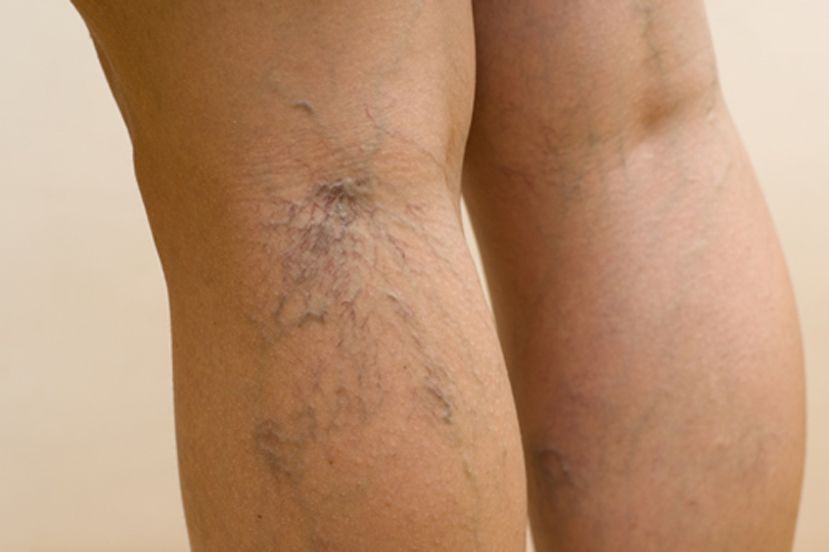 70% de úlceras en piernas se deben a la insuficiencia venosa