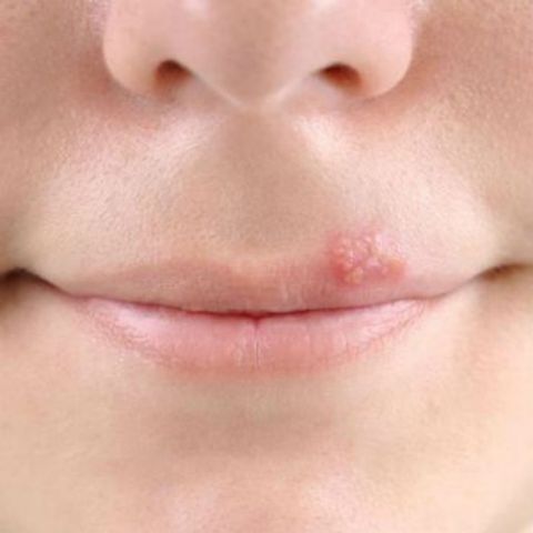 Fuegos labiales: evita contagios