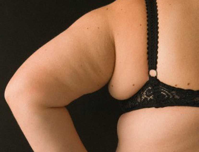 Sobrepeso factor para desarrollar cáncer de mama